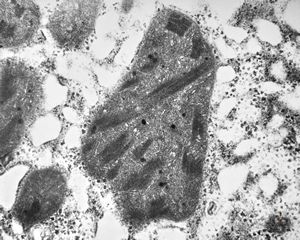 M,15y. | Wilson disease - megamitochondria M,15y. | Wilson disease - megamitochondria